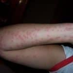 bed bug bites