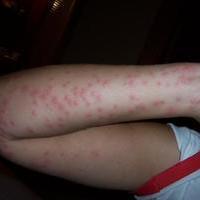 bed bug bites